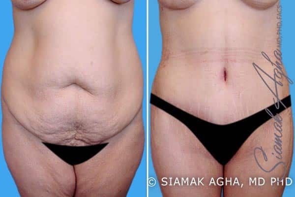 Lower Body Lift Before & After