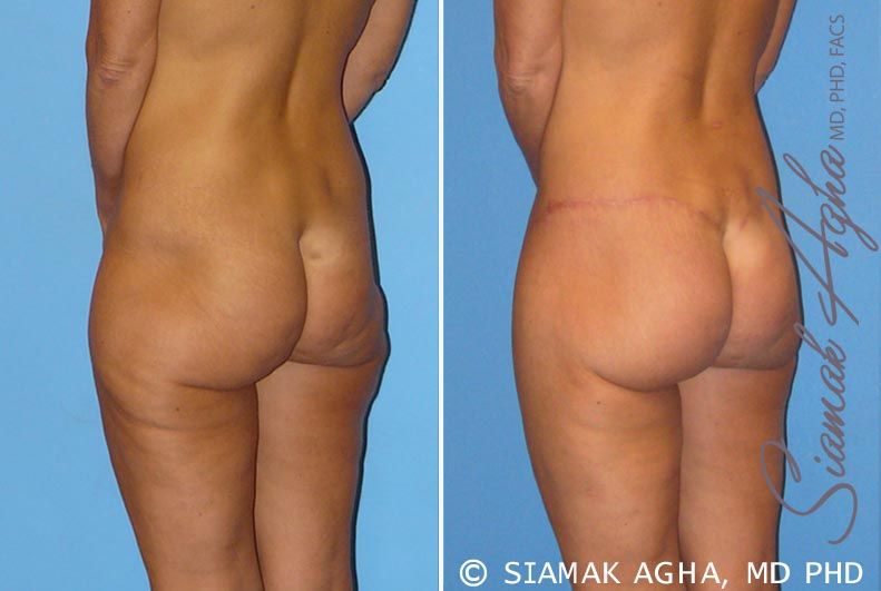 Lower Body Lift Before & After