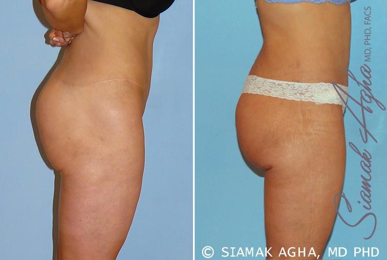 Lower Body Lift Before & After