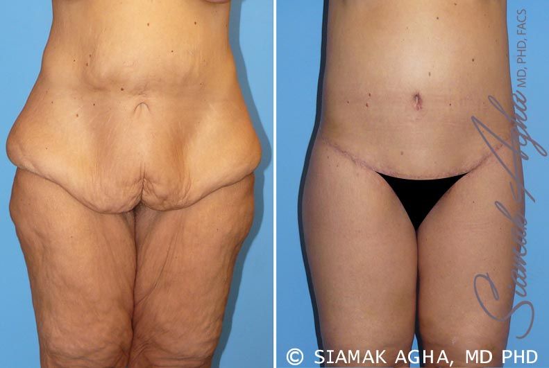 Lower Body Lift Before & After