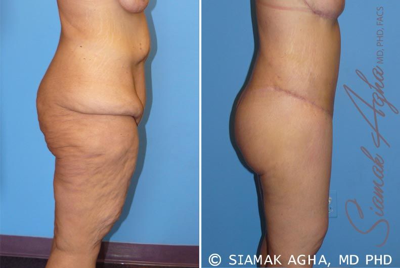 Lower Body Lift Before & After