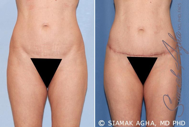 Lower Body Lift Before & After