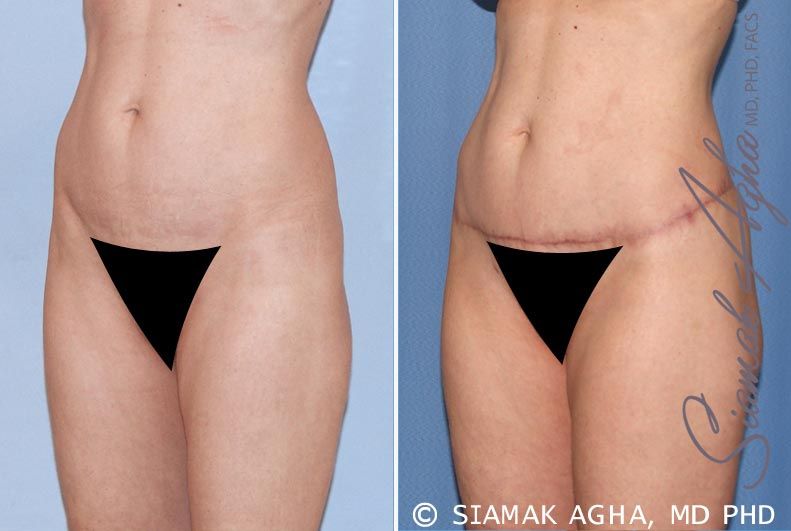 Lower Body Lift Before & After