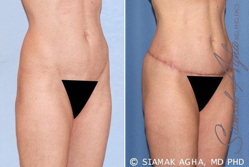 Lower Body Lift Before & After