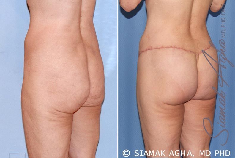 Lower Body Lift Before & After