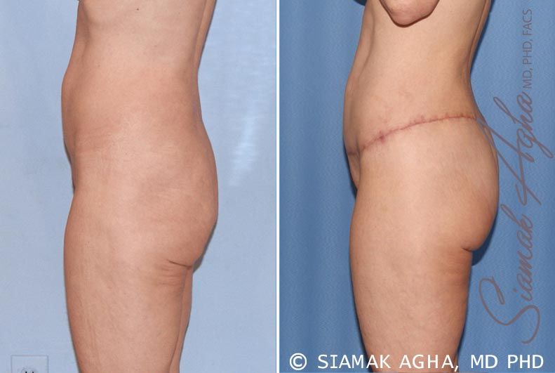 Lower Body Lift Before & After