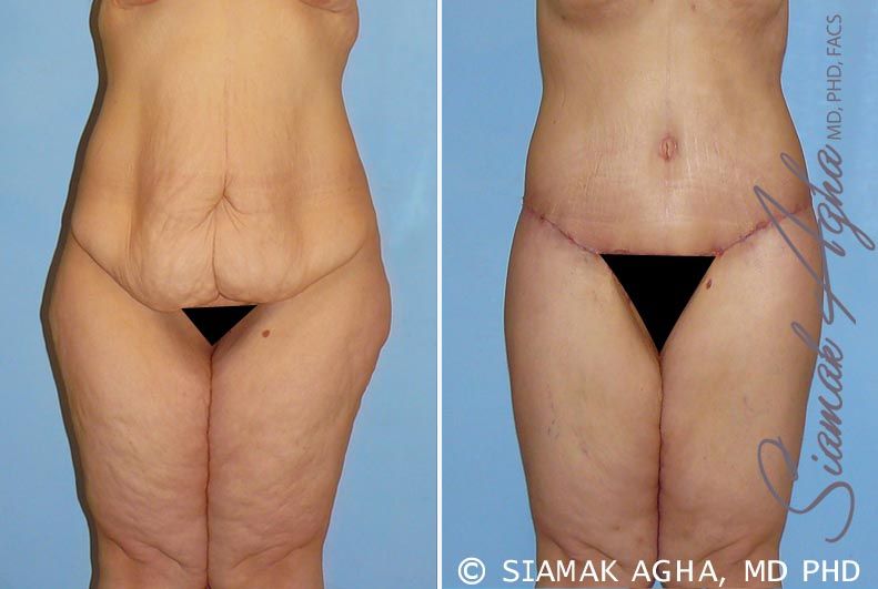 Lower Body Lift Before & After