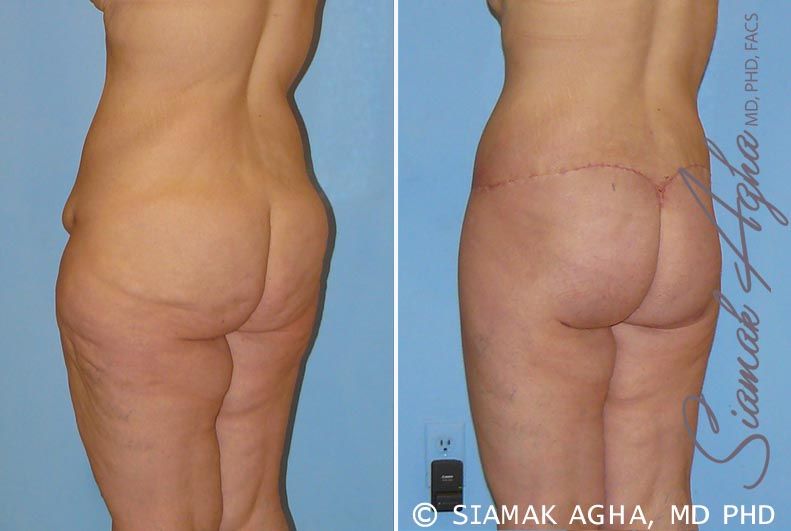 Lower Body Lift Before & After