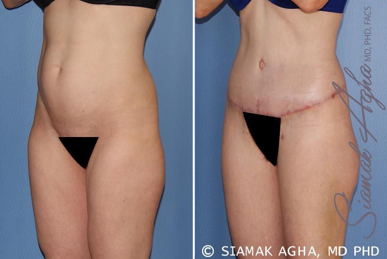 Lower Body Lift Before & After