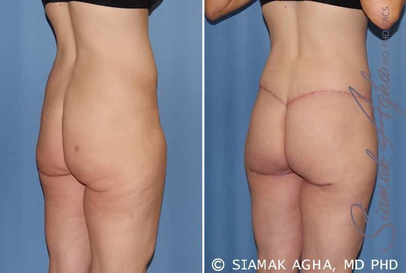 Lower Body Lift Before & After