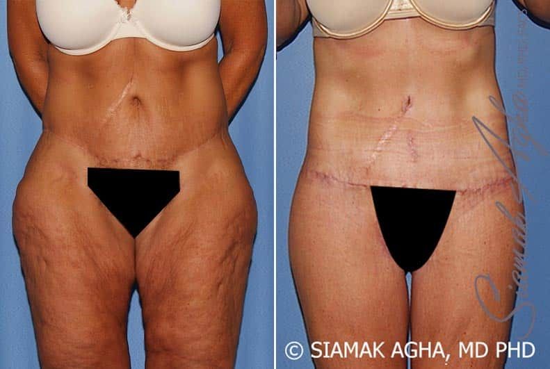 Lower Body Lift Before & After