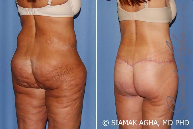 Lower Body Lift Before & After