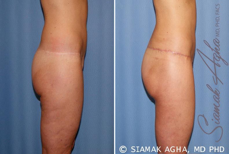 Lower Body Lift Before & After