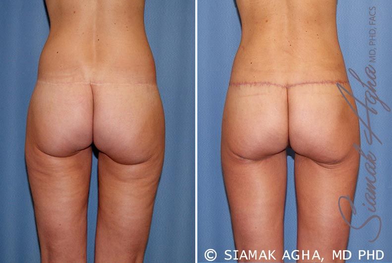 Lower Body Lift Before & After