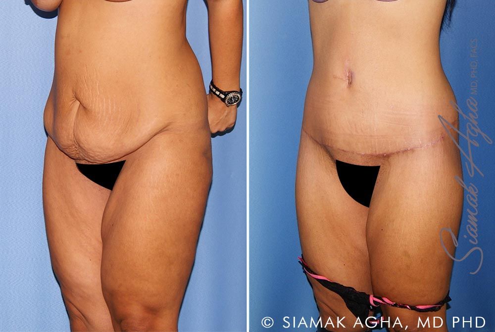 Lower Body Lift Before & After