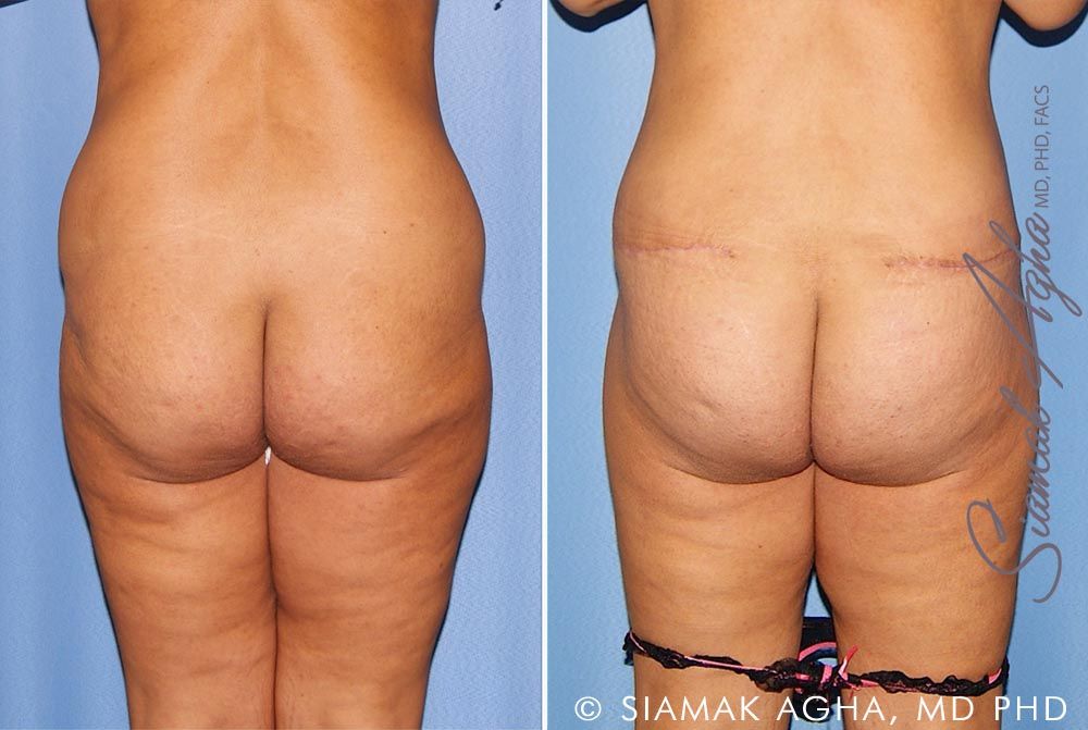 Lower Body Lift Before & After