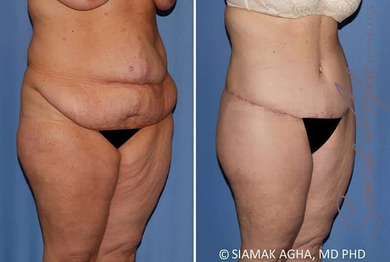 Lower Body Lift Before & After