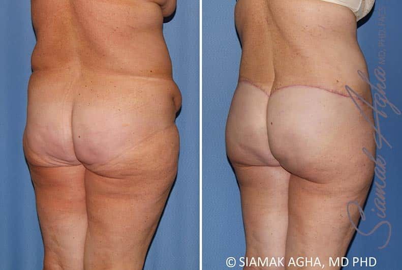 Lower Body Lift Before & After