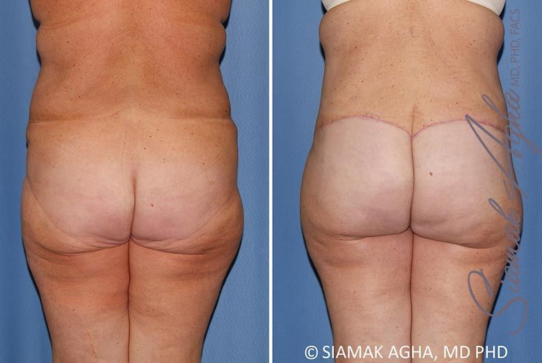Lower Body Lift Before & After