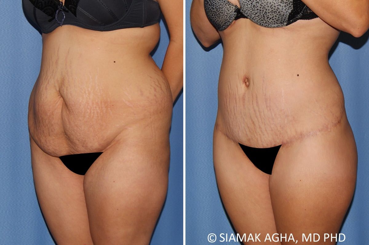 Lower Body Lift Before & After