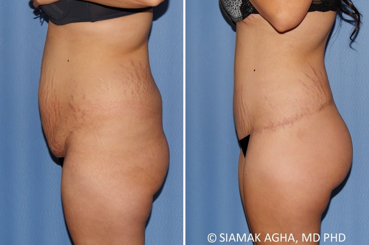 Lower Body Lift Before & After