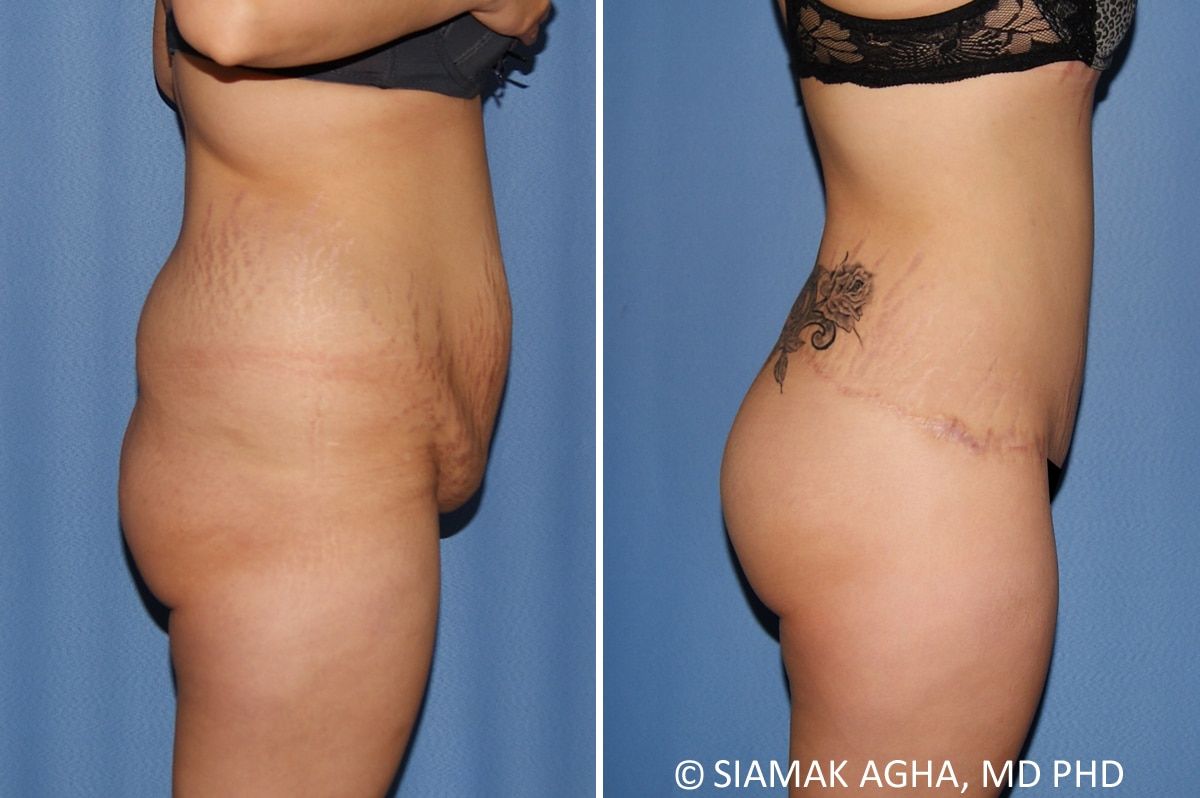 Lower Body Lift Before & After