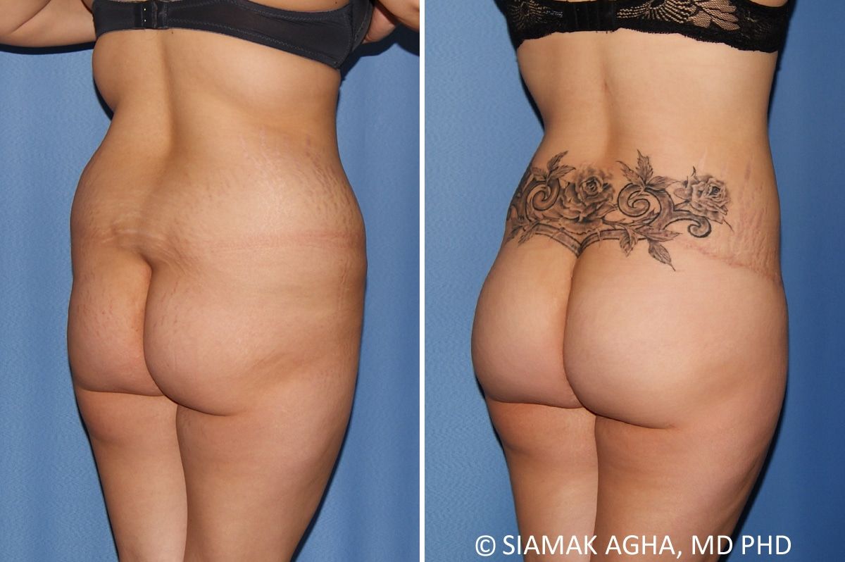 Lower Body Lift Before & After