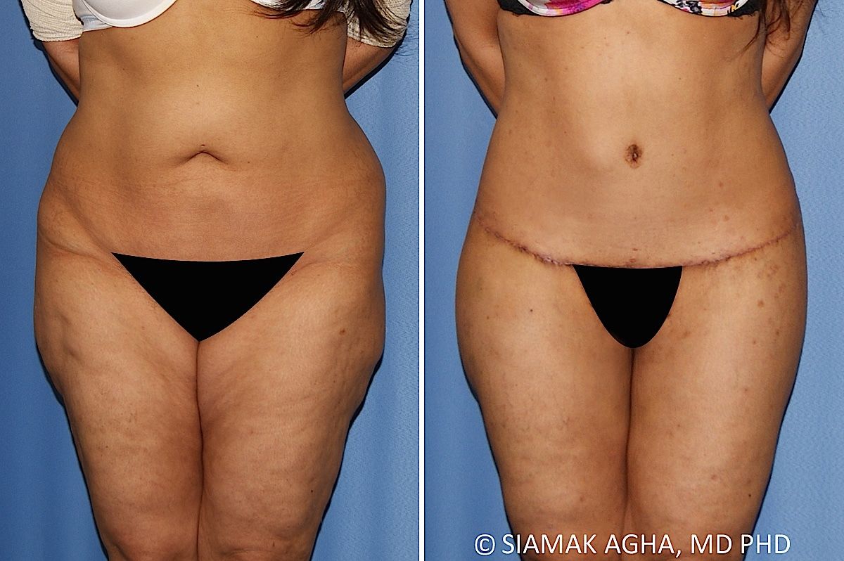 Lower Body Lift Before & After