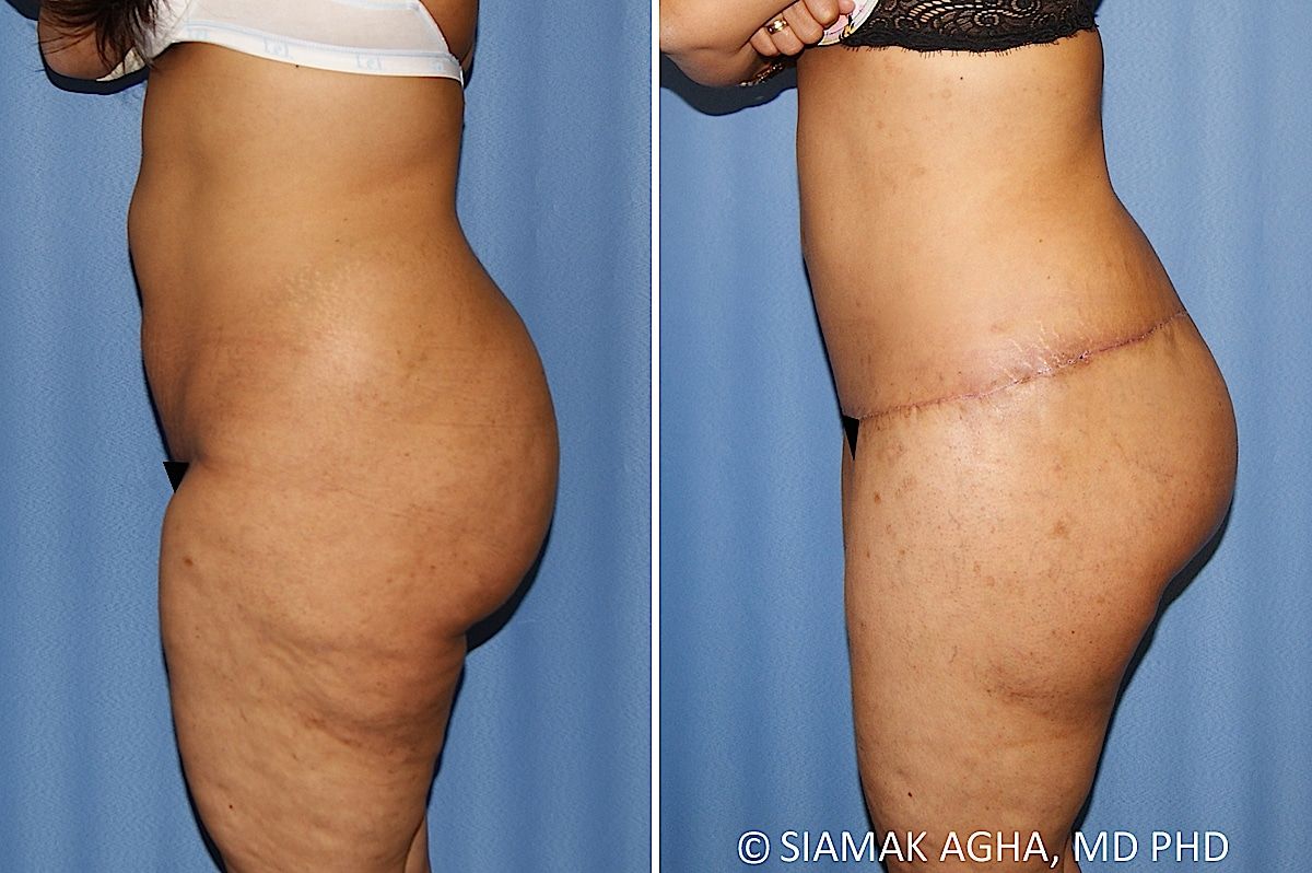 Lower Body Lift Before & After