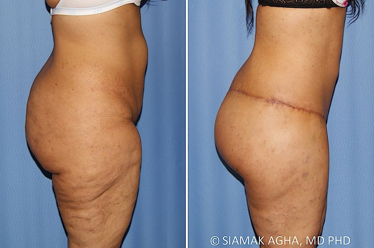 Lower Body Lift Before & After