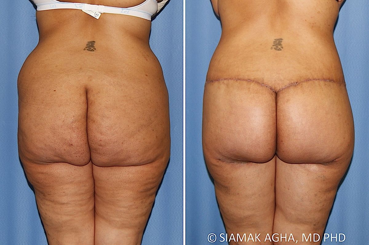 Lower Body Lift Before & After