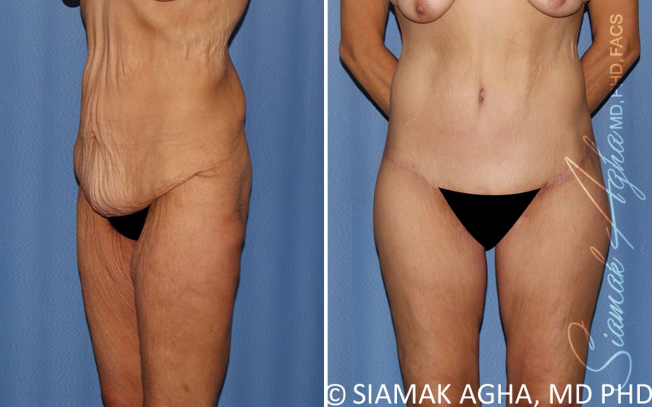 Lower Body Lift Before & After