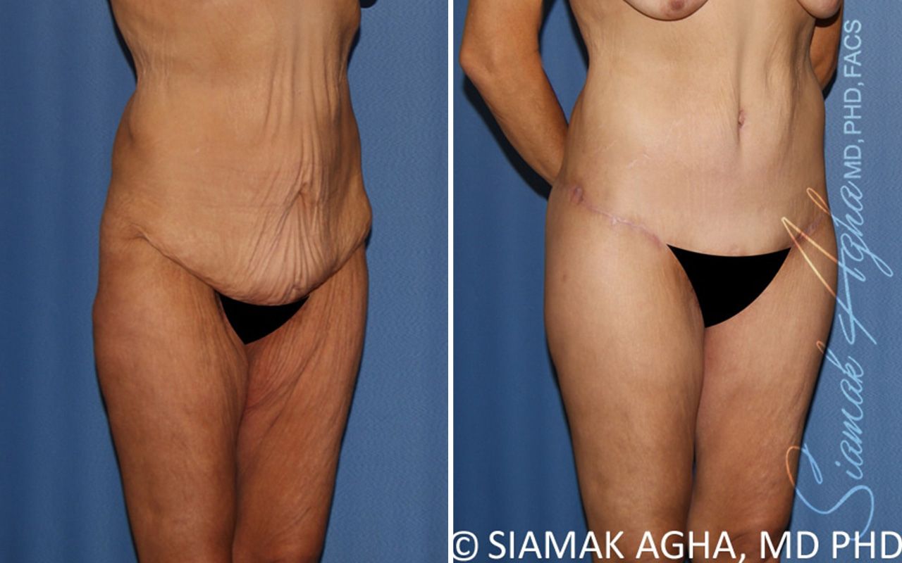 Lower Body Lift Before & After