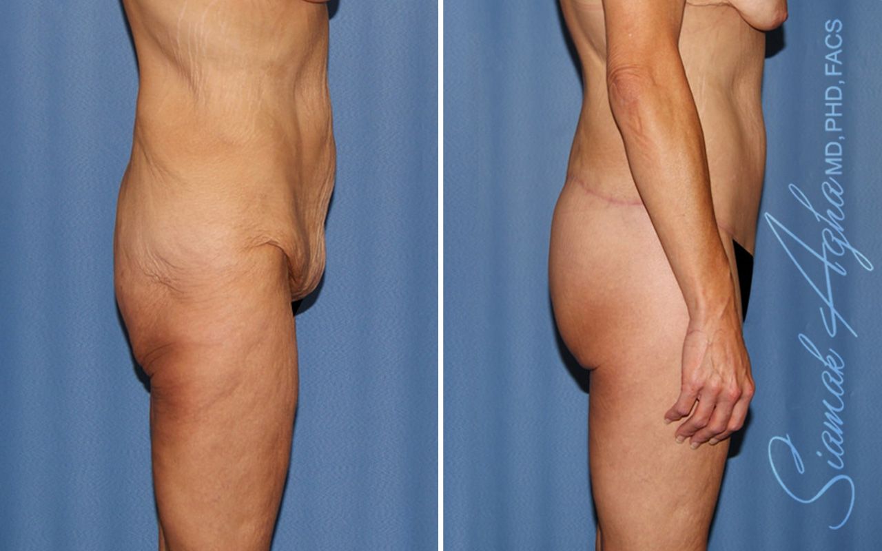 Lower Body Lift Before & After