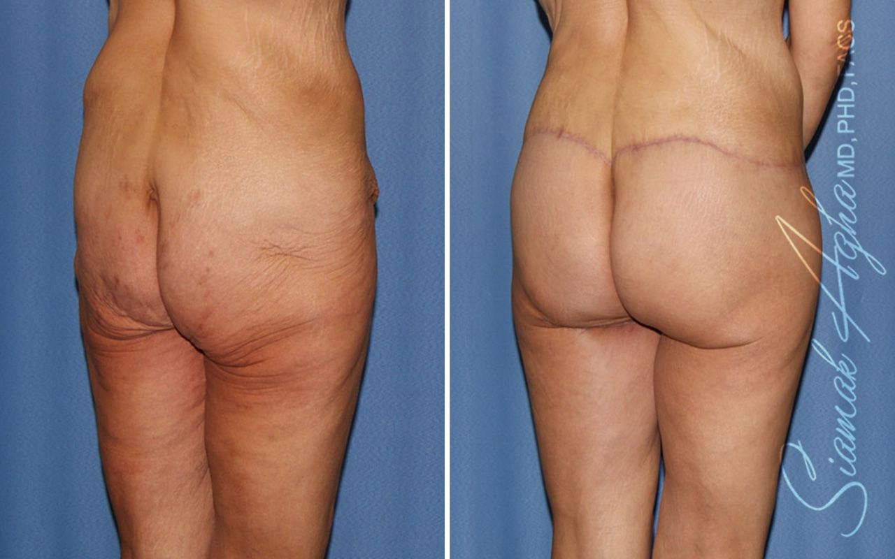 Lower Body Lift Before & After