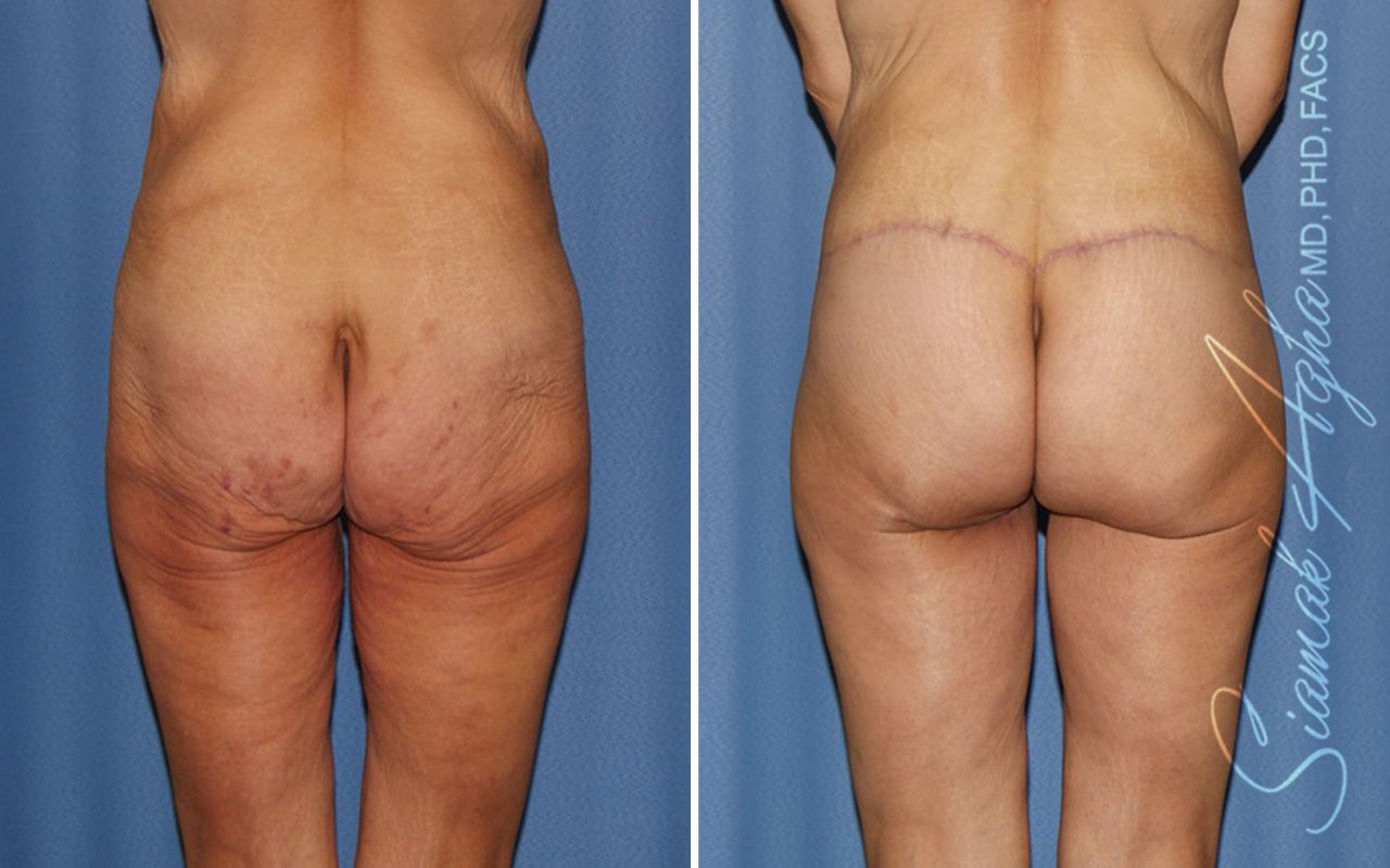 Lower Body Lift Before & After