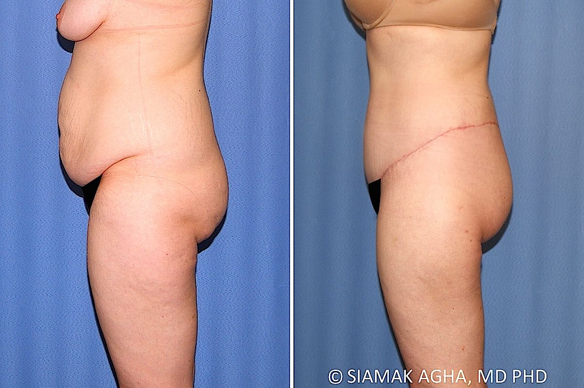 Lower Body Lift Before & After