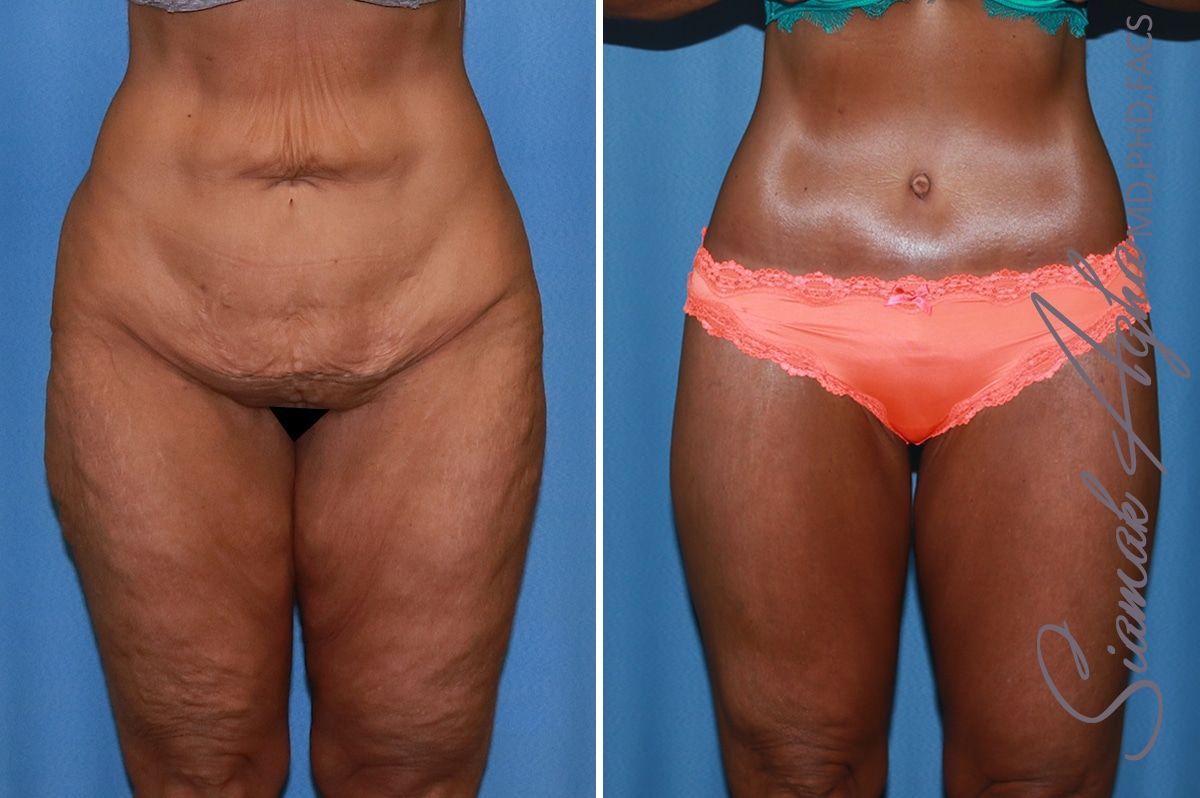 Lower Body Lift Before & After