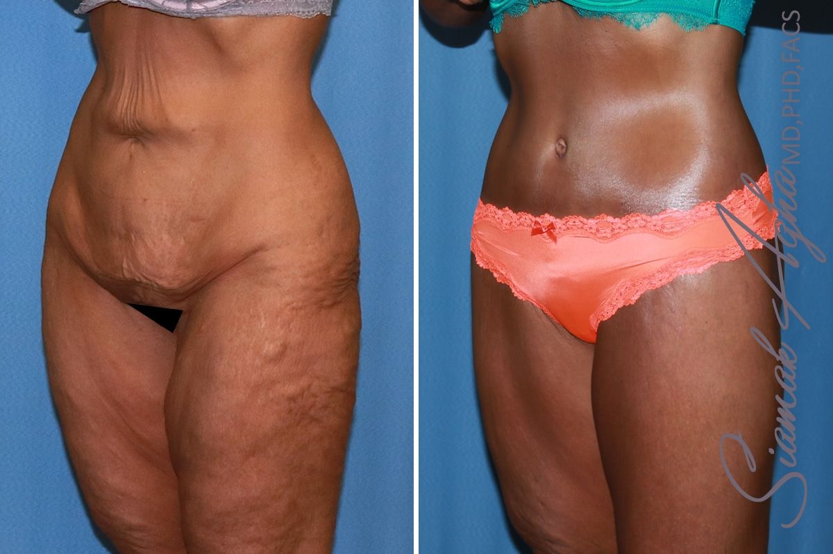 Lower Body Lift Before & After