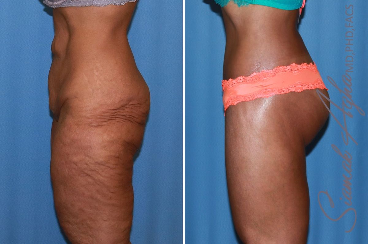 Lower Body Lift Before & After