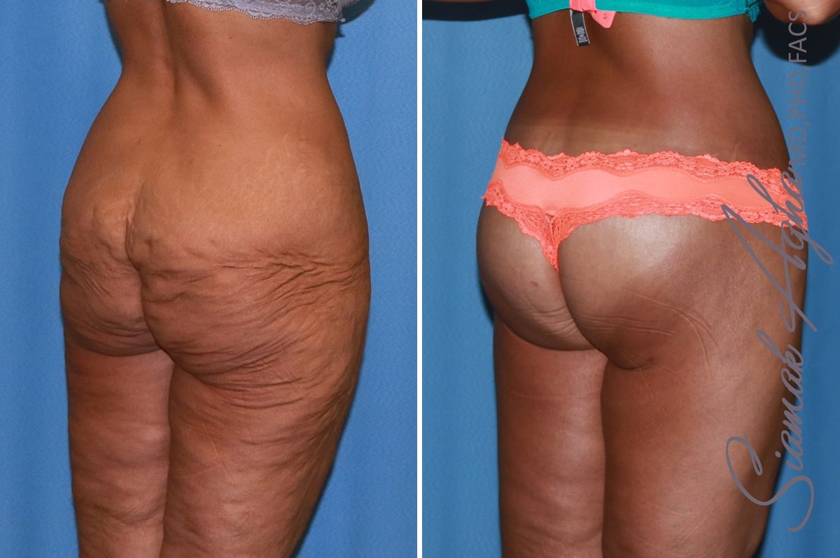 Lower Body Lift Before & After