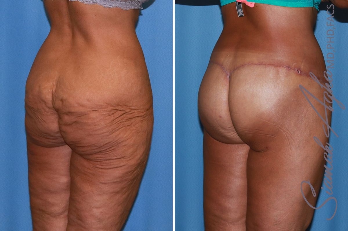 Lower Body Lift Before & After