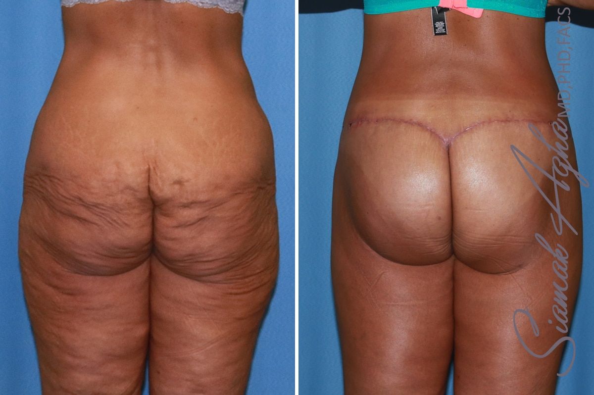 Lower Body Lift Before & After