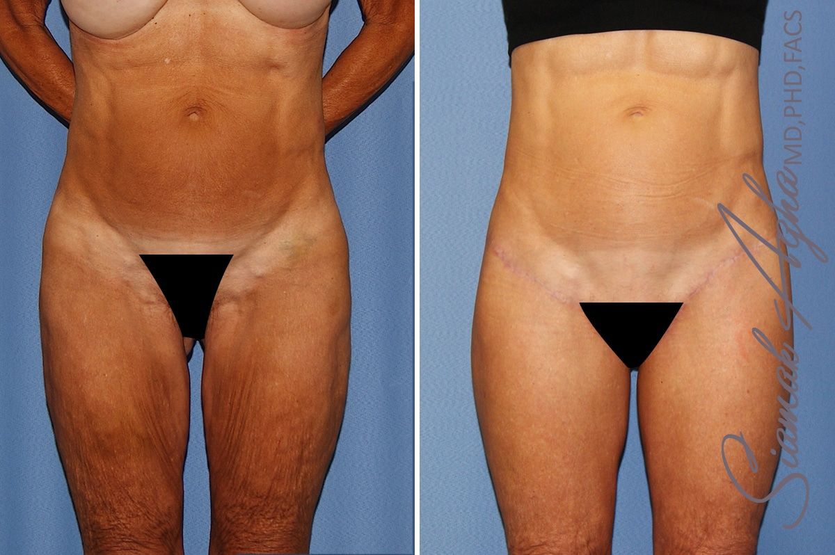 Lower Body Lift Before & After