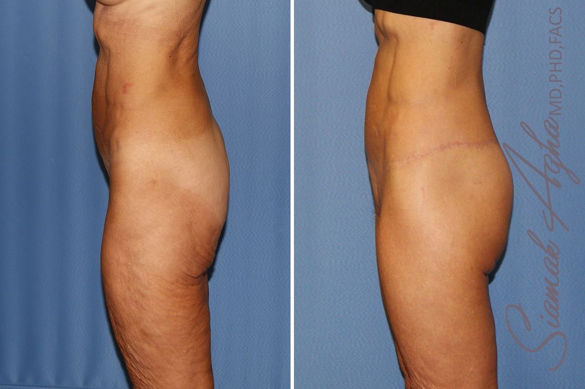 Lower Body Lift Before & After