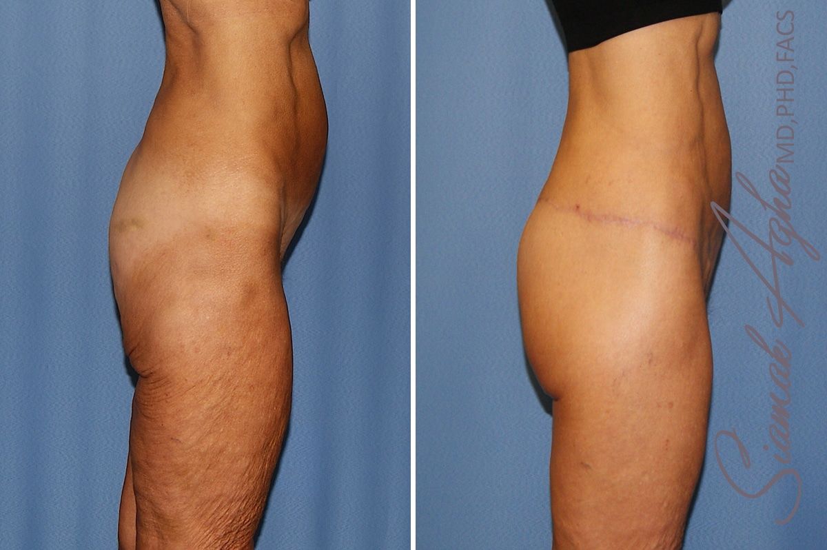 Lower Body Lift Before & After