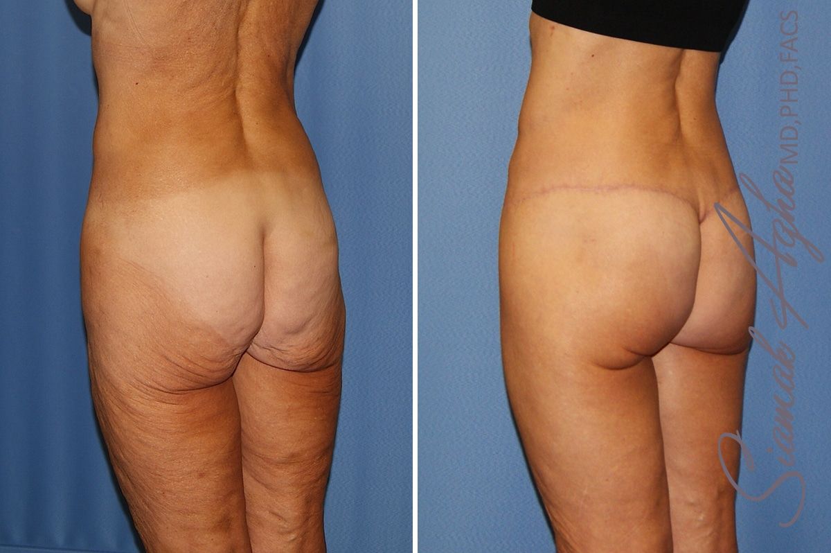 Lower Body Lift Before & After