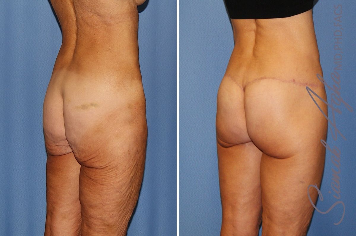 Lower Body Lift Before & After