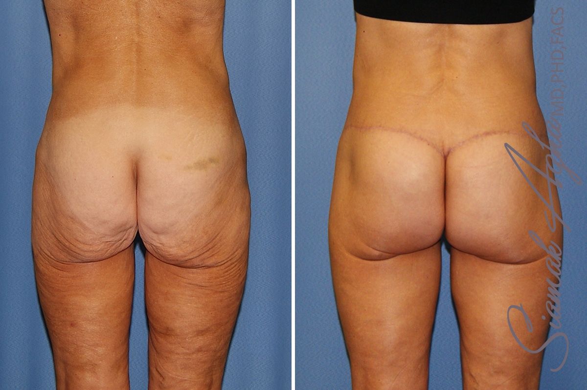 Lower Body Lift Before & After