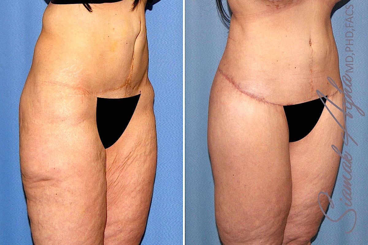 Lower Body Lift Before & After